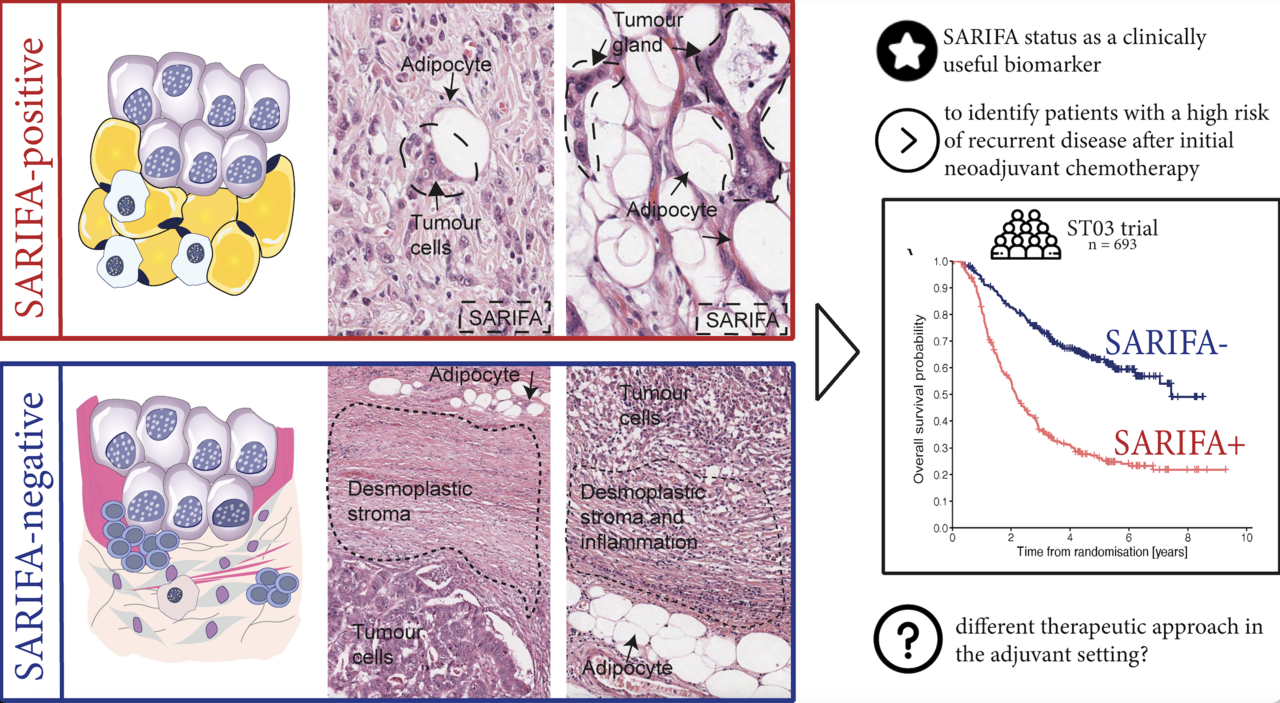 Behind the Paper: Stroma AReactive Invasion Front Areas (SARIFA) improves prognostic risk stratification of perioperative chemotherapy treated oesophagogastric cancer patients from the MAGIC and the ST03 trial