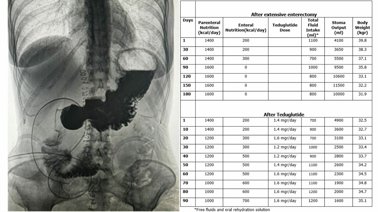 Managing Fluid Balance and Nutritional Status in a Short Bowel Syndrome Patient awaiting Intestinal Transplant: A Case Report.