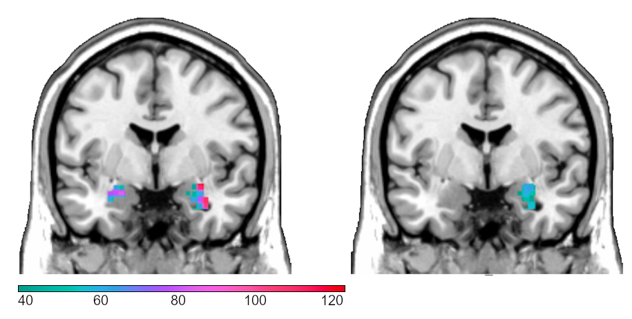 Persistence of amygdala hyperactivity to subliminal negative emotion processing in the long-term course of depression