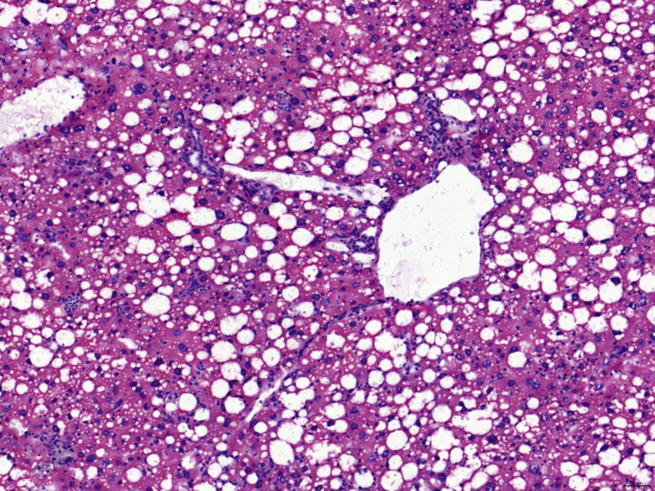 Transcriptomics-driven metabolic pathway analysis reveals similar alterations in lipid metabolism in mouse MASH model and human