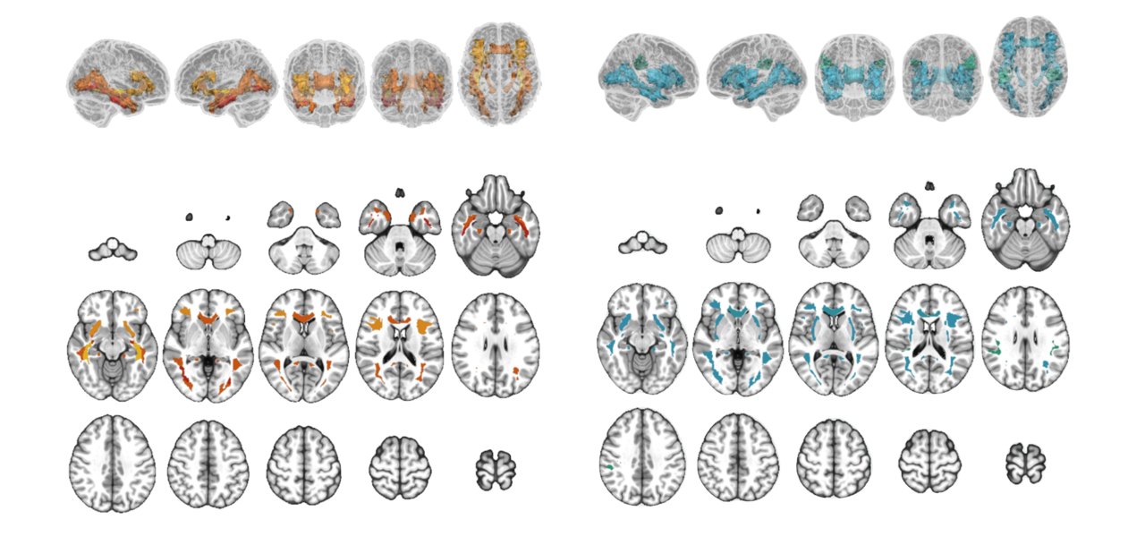 Influences of amyloid-β and tau on white matter neurite alterations in dementia with Lewy bodies