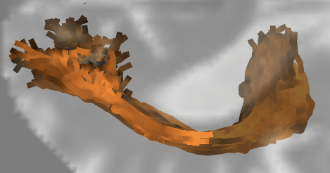 Convolutional neural network-based classification of glaucoma using optic radiation tissue properties