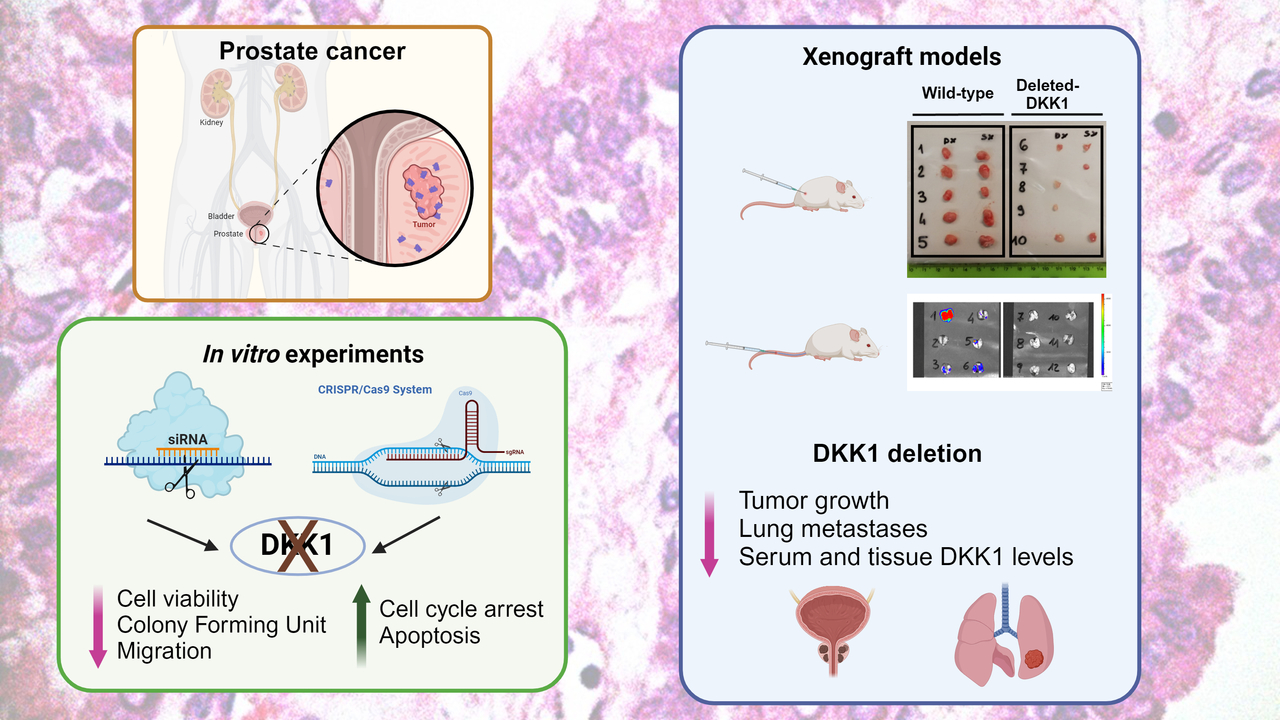 Dickkopf-1 (DKK1) drives growth and metastases in castration-resistant prostate cancer