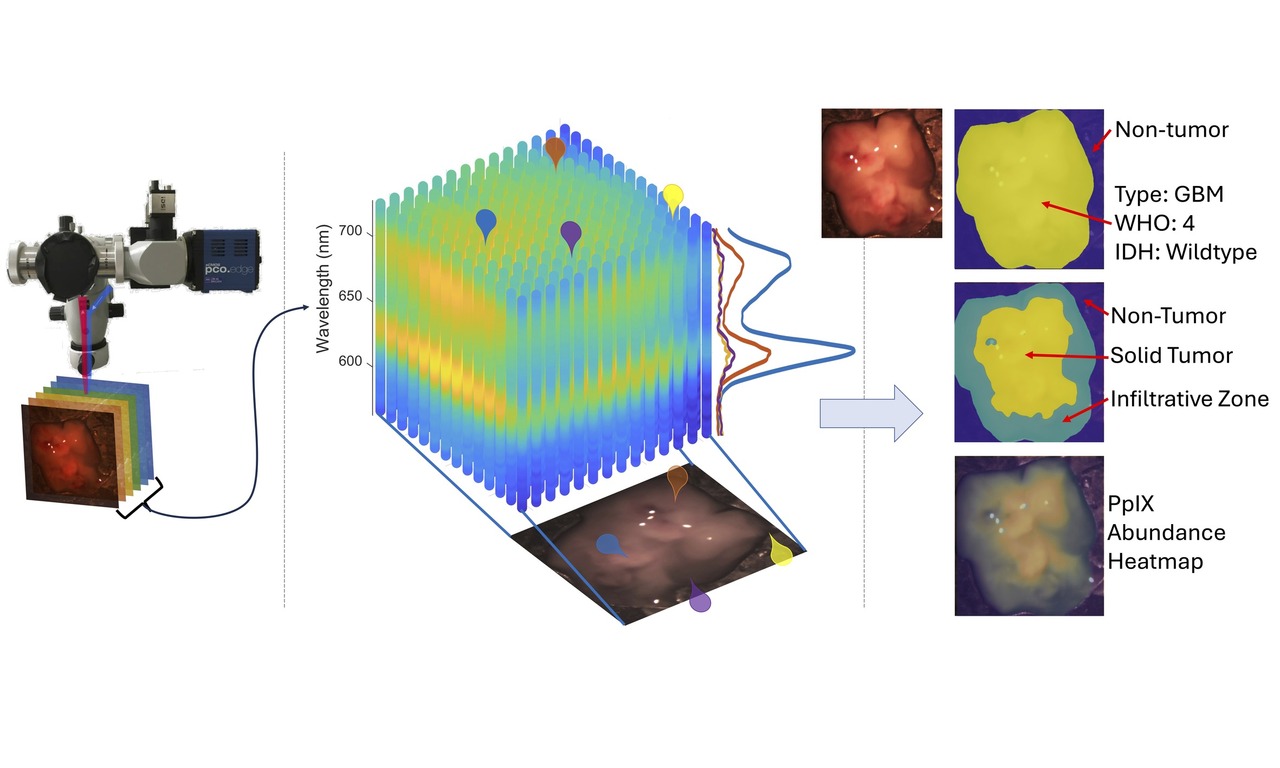 Revolutionizing Brain Tumor Surgery with Hyperspectral Imaging and Artificial Intelligence