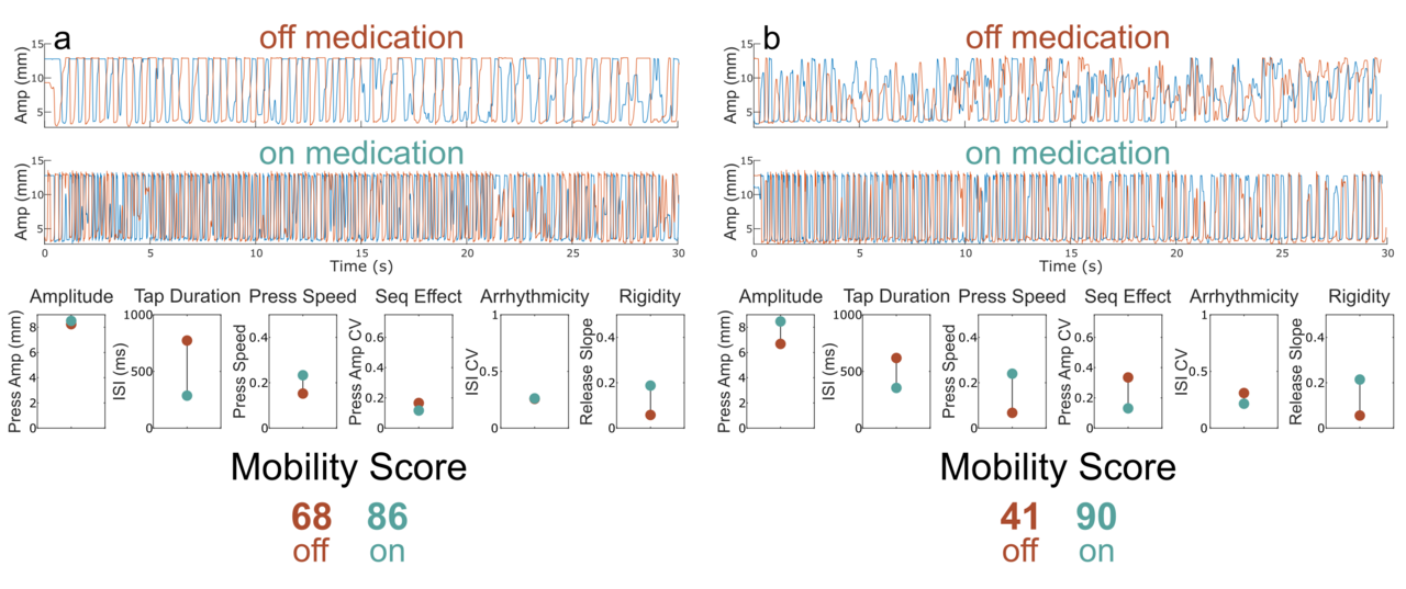 Comprehensive real time remote monitoring for Parkinson’s disease using Quantitative DigitoGraphy
