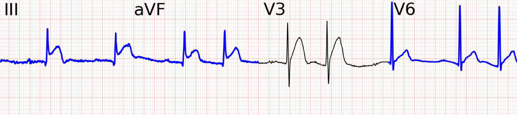 AI Reconstruction of the 12-Lead ECG via 3-Leads with Accurate Clinical Assessment