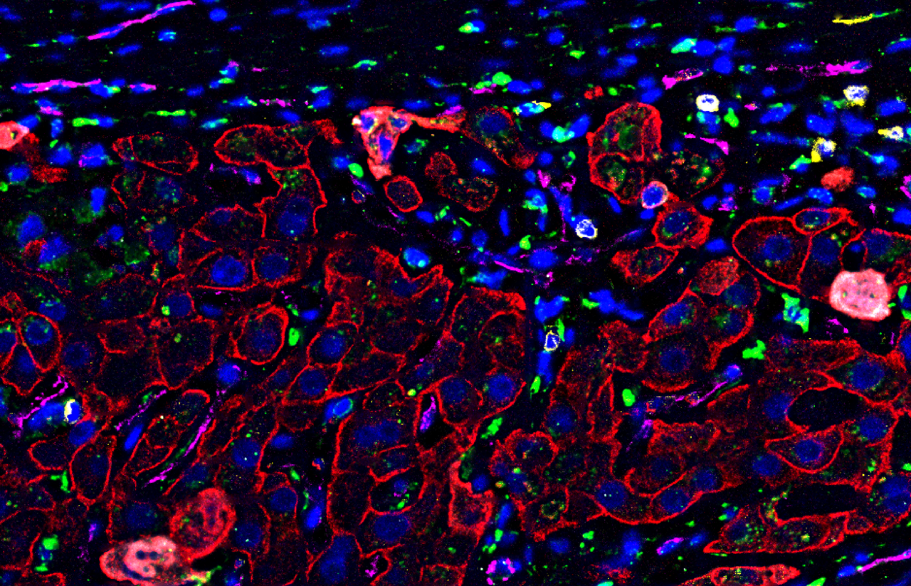 Behind Enemy Lines: How Cancer Persists by Hiding from our Immune System