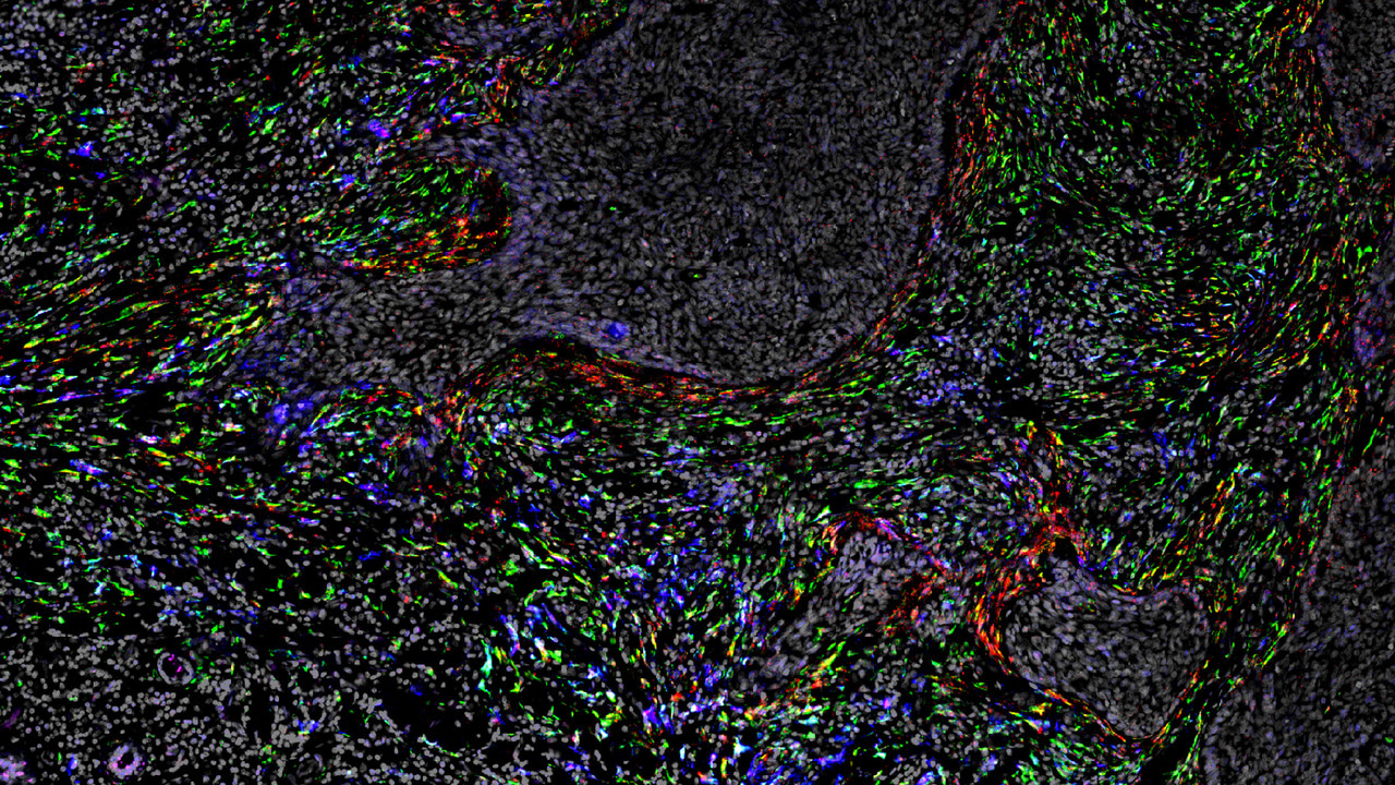 From Benign to Malignant: How iCAFs Shape the Skin Cancer Landscape