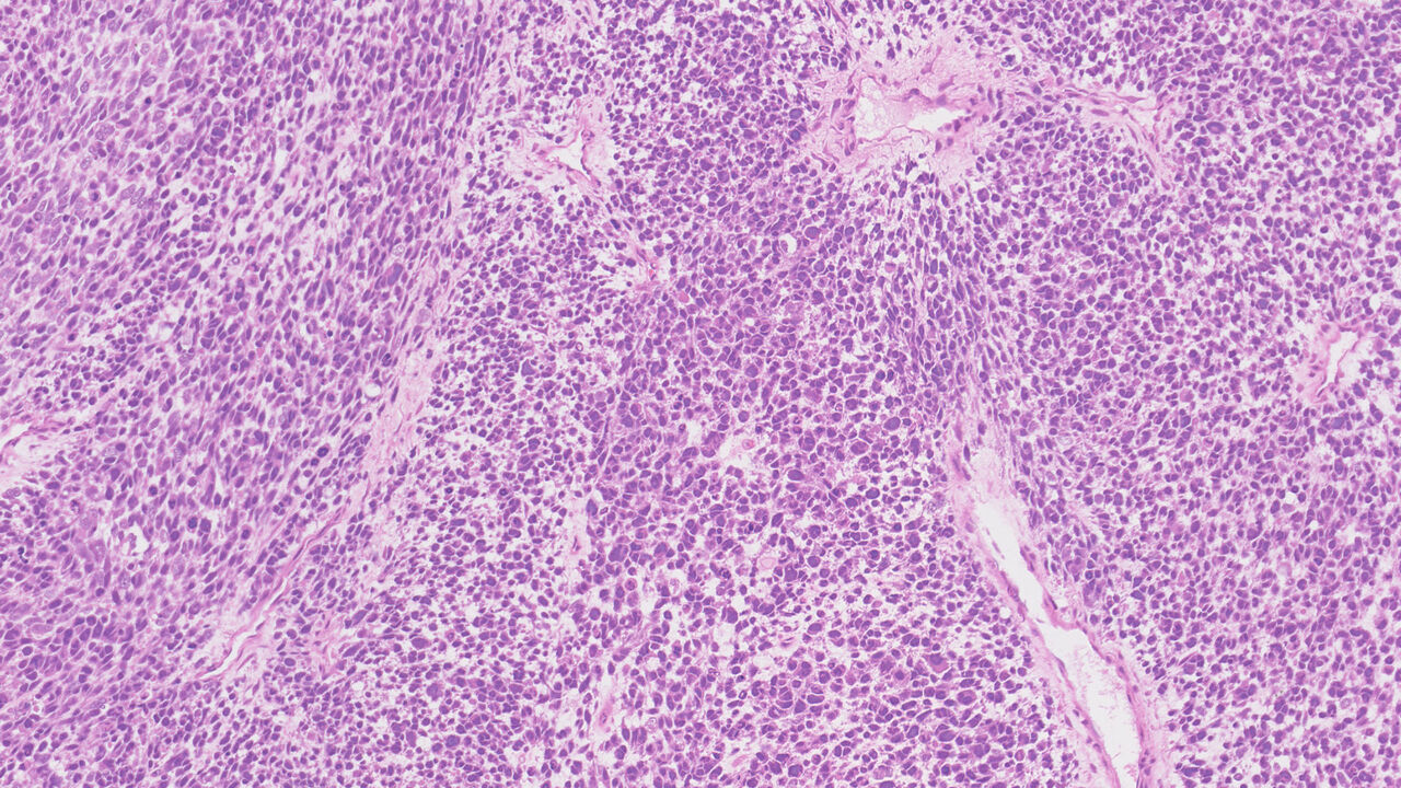 Double Trouble: Whole Genome Duplication & Immune Disruption in Testicular Cancers