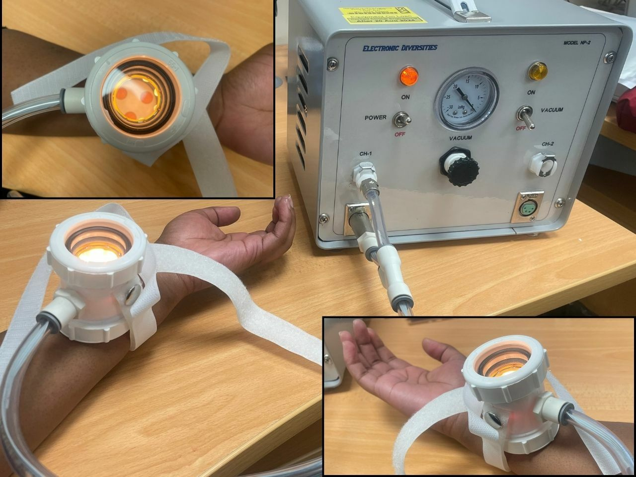 A Novel Method To Understand Staphylococcus aureus Skin and Soft Tissue Infection