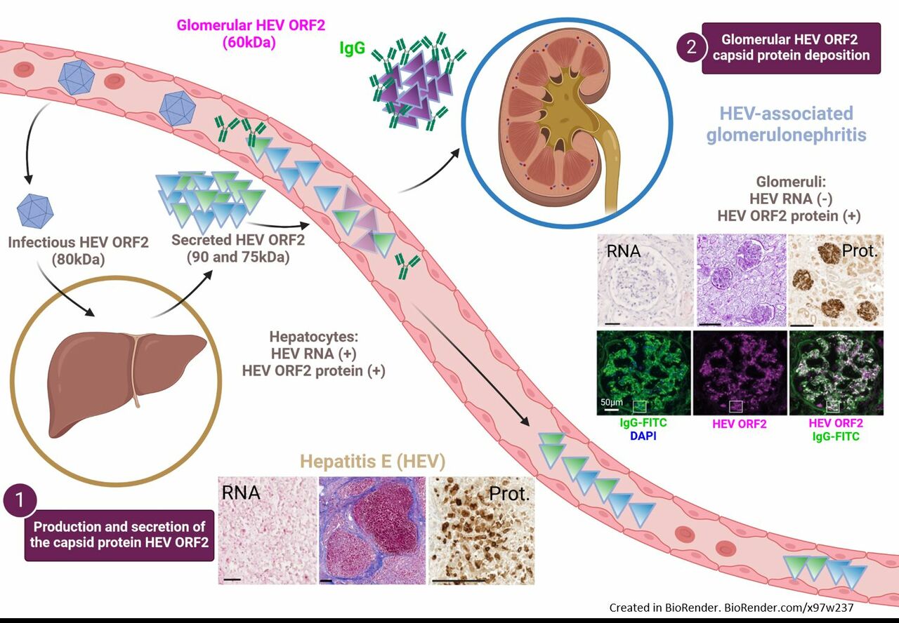 “When death delights in helping the living” – by unraveling a link between hepatitis E and kidney disease