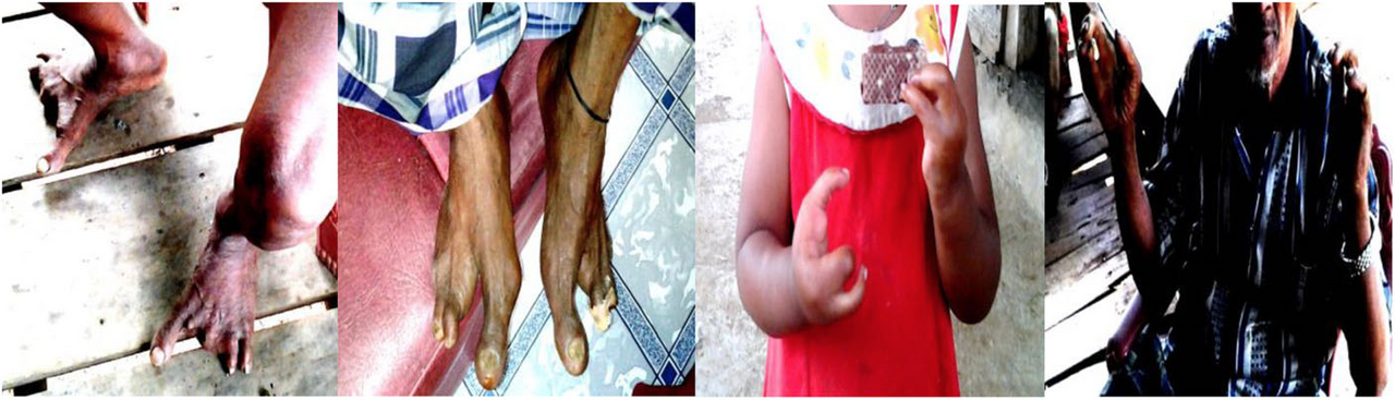 Self-Meaning of Oligodactyly: Health Communication Study of People with Oligodactyly in the Village of Ulutaue, South Sulawesi, Indonesia