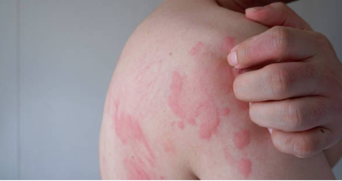 Recurrent hives and chronic itch after repeated exposure to mRNA vaccines