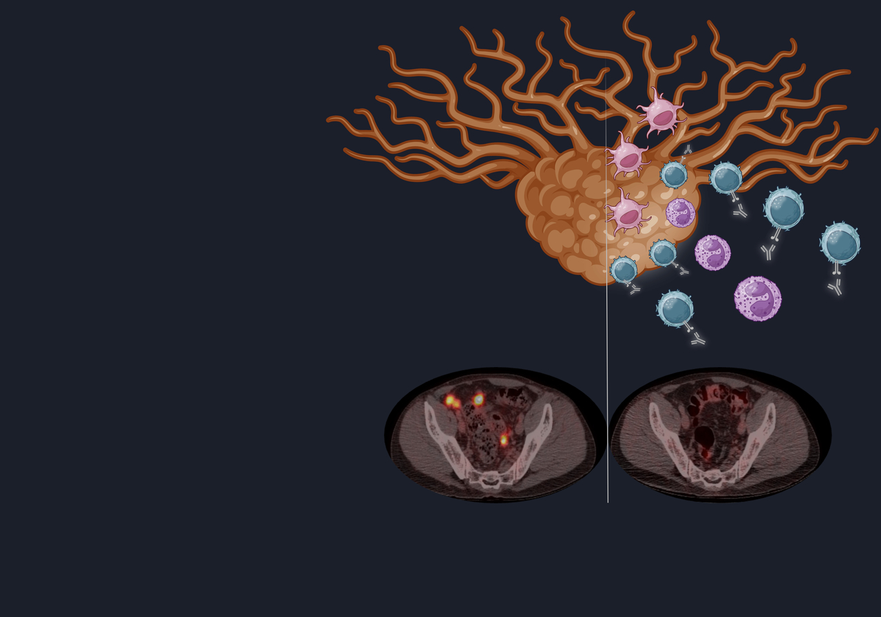 From a remarkable response to anti-PD-1 rechallenge to a cancer-free assisted dying