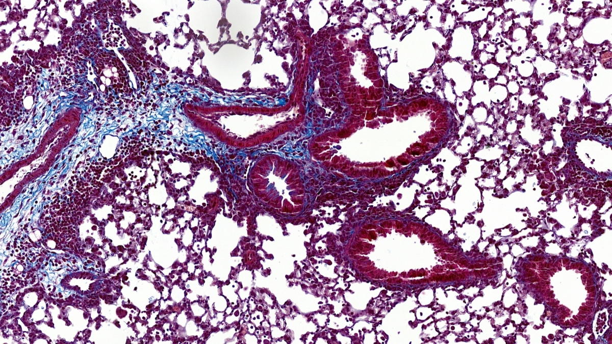 Filamins in type 2 inflammation in asthma, a matter of balance