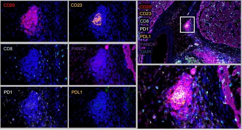 Tertiary lymphoid structures potentially promote immune checkpoint inhibitor response in SMARCB1-deficient medullary renal cell carcinoma