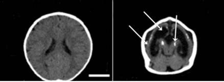 Congenital Zika syndrome (CZS): lessons from twins