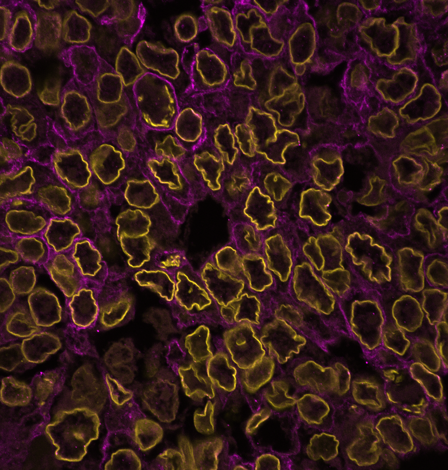Extreme wrinkling of the nuclear lamina is a morphological marker of cancer