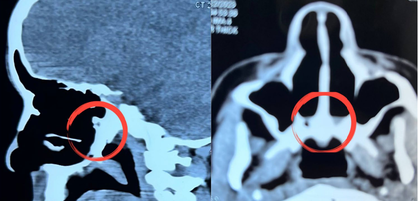 How it is possible to see Awoman in mid twenties with Bilateral Choanal atresia ?