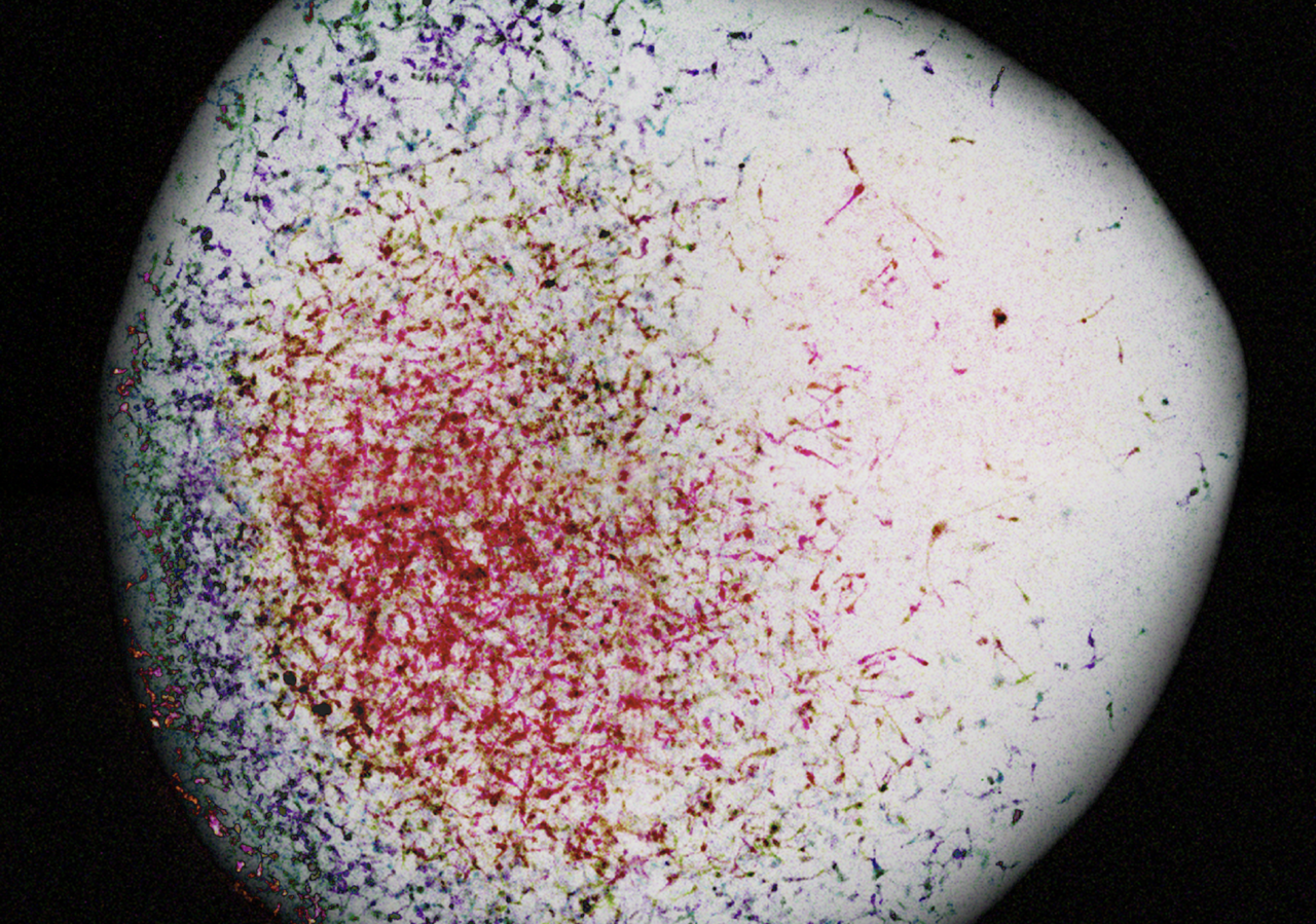 From development to tumorigenesis:  novel human brain organoids 