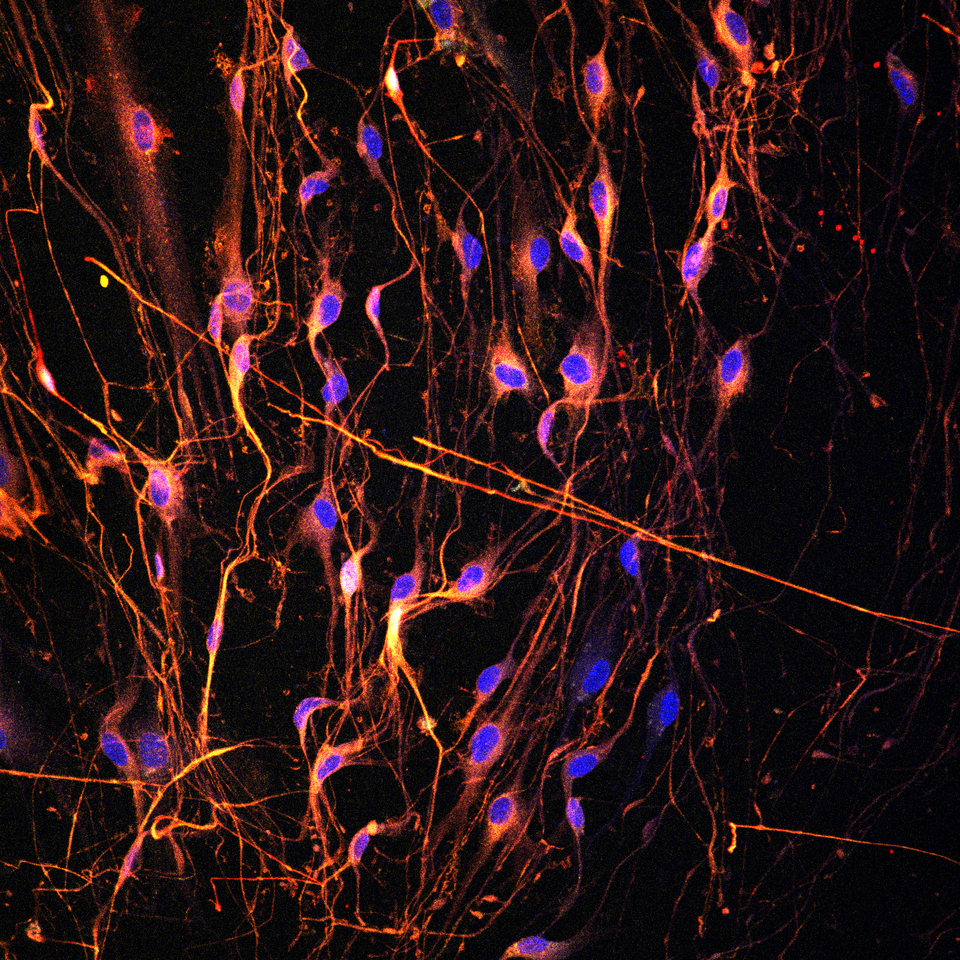 Chasing Ghosts – The Quest to Capture Neurons in Pancreatic Cancer