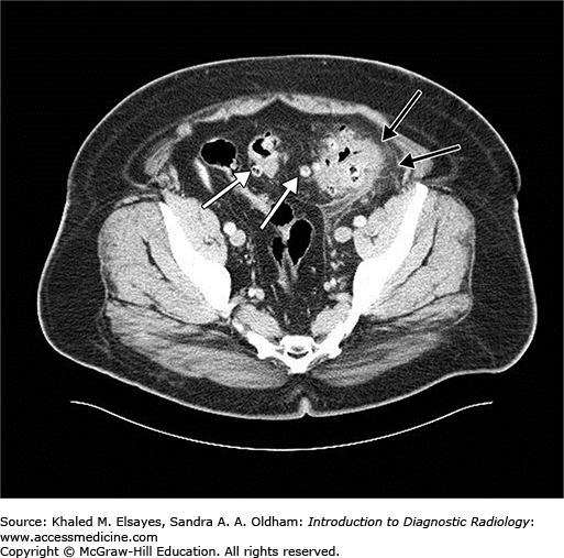 AccessMedicine's Image of the Week Diverticulitis on CT Abdomen
