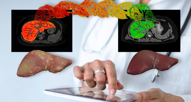 Breaking the Mould: How LiverMultiScan is transforming MASLD diagnosis in a cost-effective way