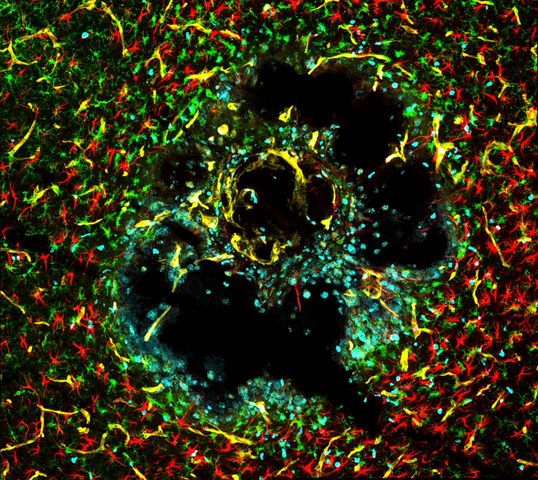 Focused sound energy stops a rare vascular neoplasm in its tracks 