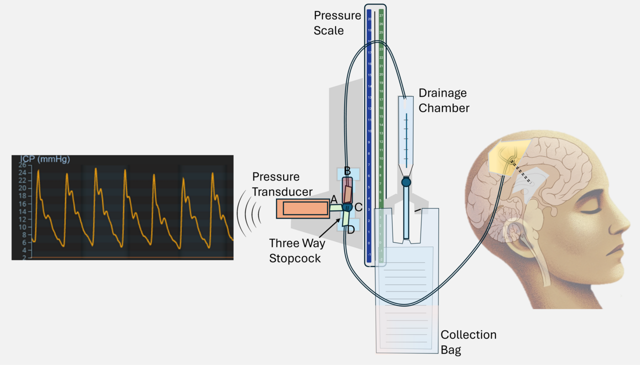 Breaking a Barrier in Intracranial Pressure Analysis