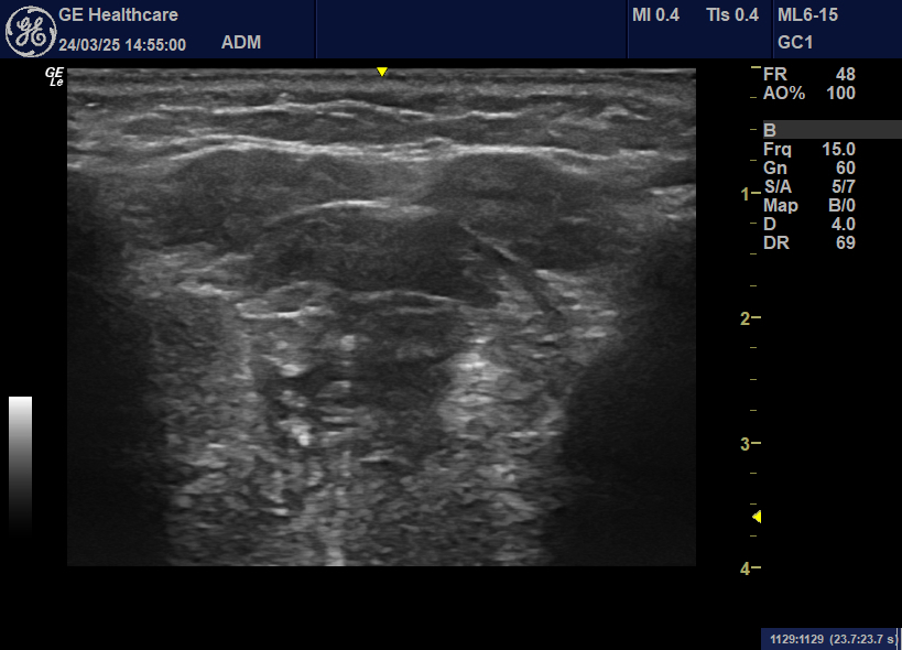 Use of ultrasound to assess muscle structure and size in key speech and swallowing tissues before and after radiotherapy