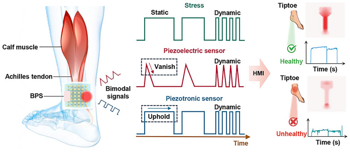 Piezotronic Sensor for Bimodal Monitoring of Achilles Tendon Behavior