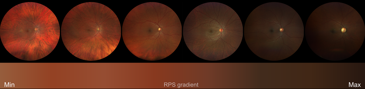 The Retinal Pigment Score: changing the game in ophthalmology by decoupling ethnicity from biology