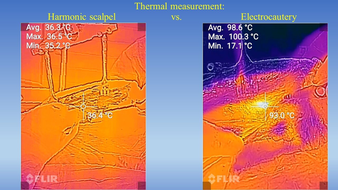 Coronary artery bypass grafting versus percutaneous coronary intervention in single-vessel left anterior descending artery disease: mid-term propensity matching study