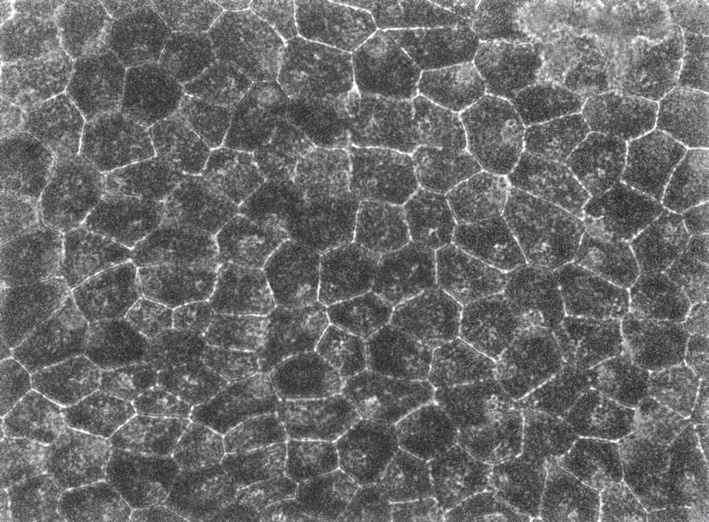 A cell patch for the treatment of blindness