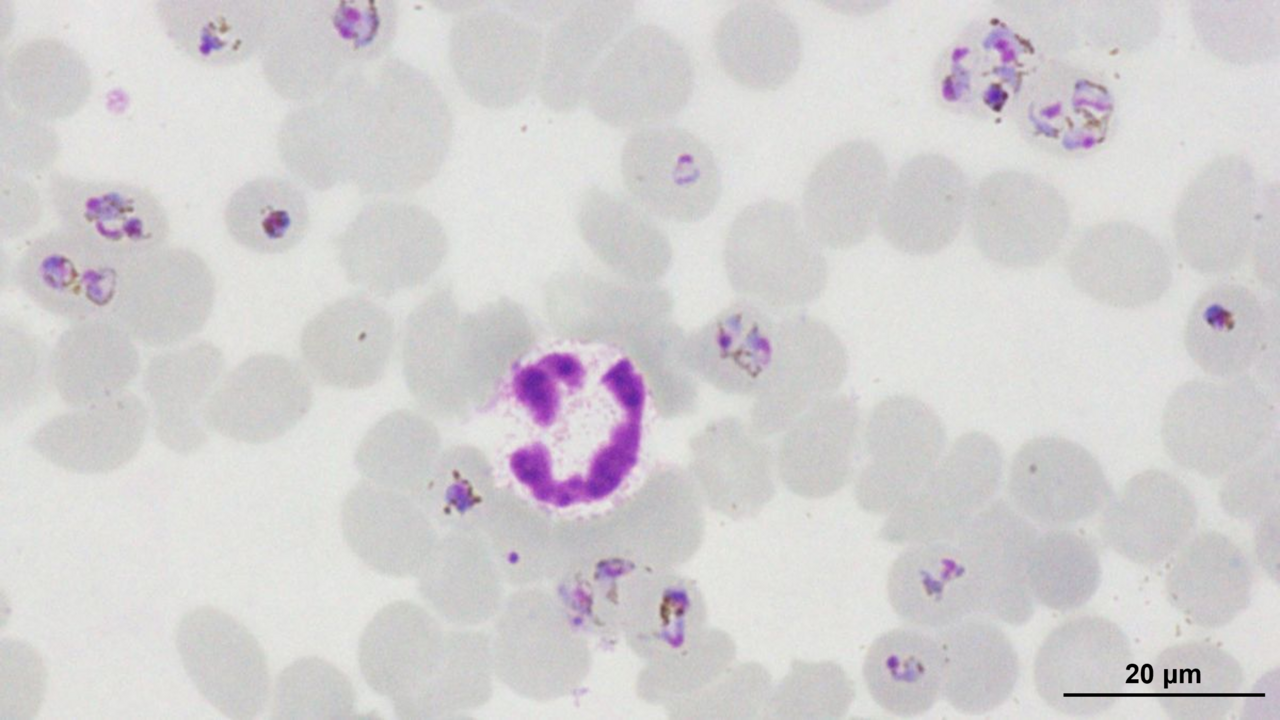Unlocking New Frontiers in Cerebral Malaria Diagnosis and Treatment: The Promise of Methylene Blue and Blood Biomarkers