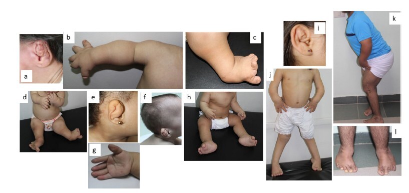 Unlocking the Genetic Code of a Rare Skeletal Disorder: A Study of Egyptian Families