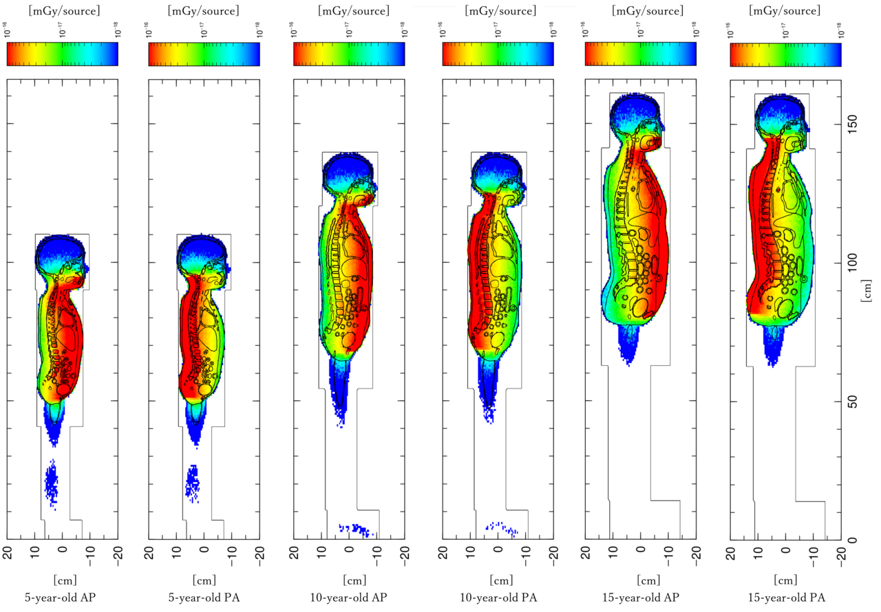 Why projection direction matters in pediatric full-spine radiography