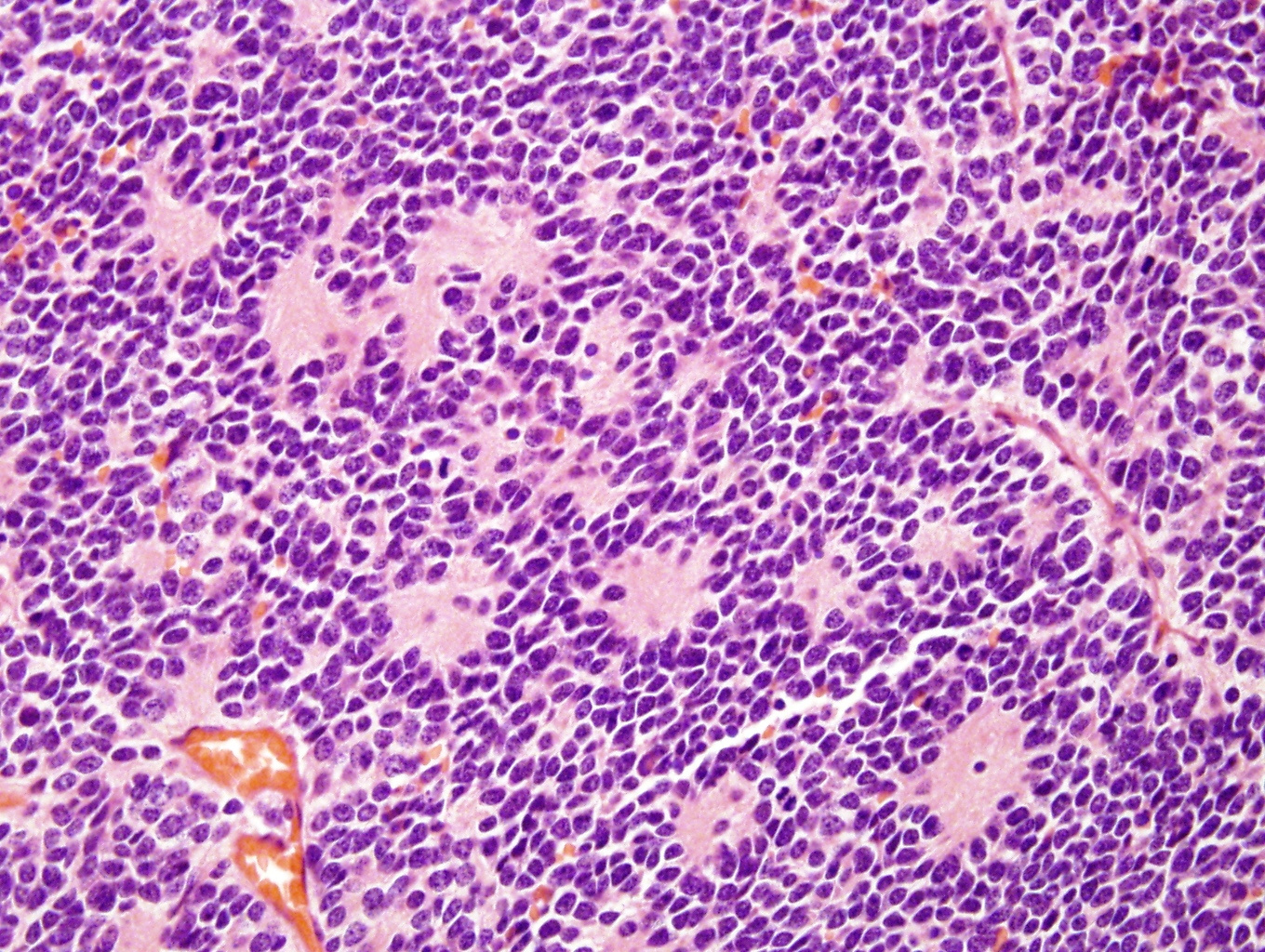 https://www.pathologyoutlines.com/imgau/adrenalneuroblastomaPerrino04.jpg