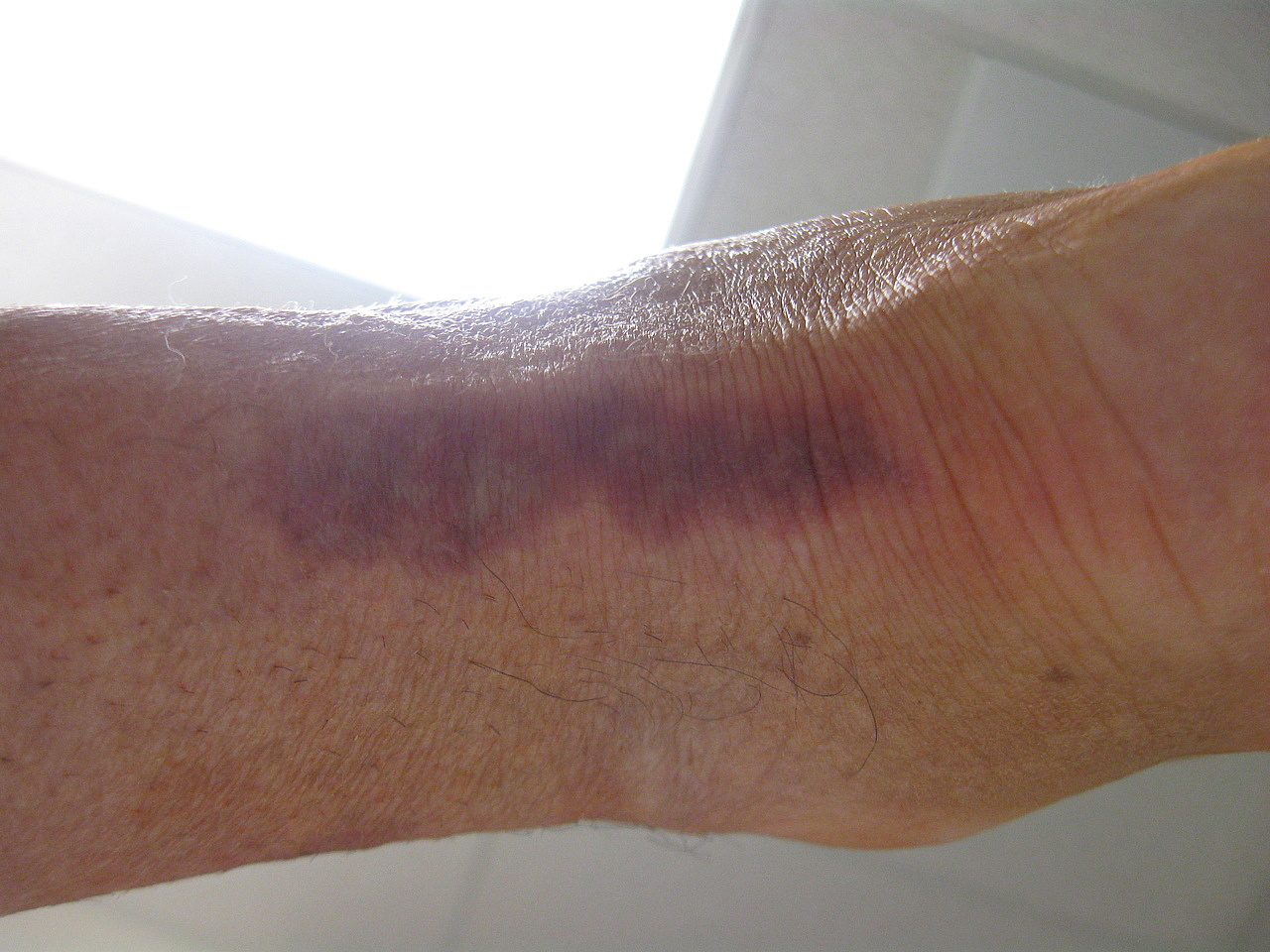 Pressure injuries AccessMedicine Network