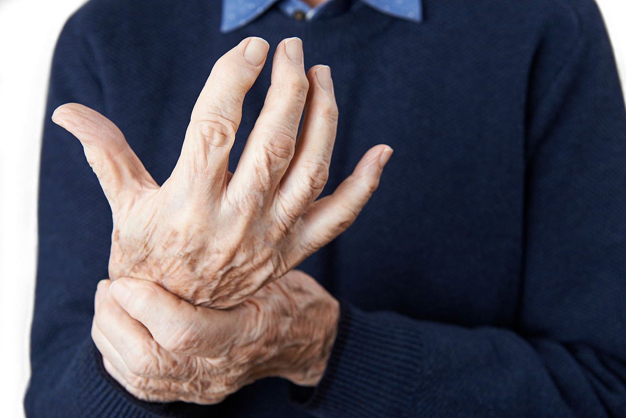 ‘New shortterm treatment option for hand osteoarthritis flareups
