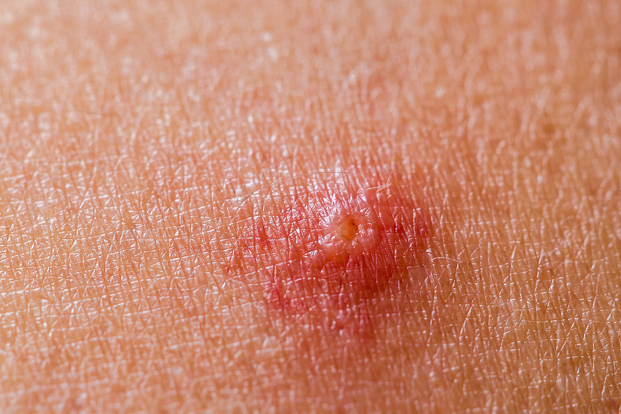 GPs should avoid antibiotics for nonbullous impetigo OnMedica
