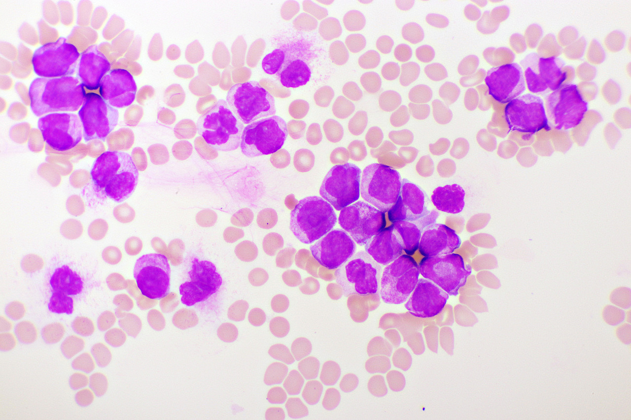 Acute myeloid leukaemia OnMedica