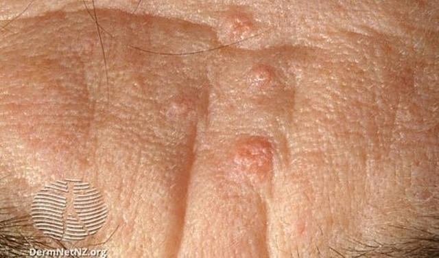 Skin Dermatome Guide OnMedica