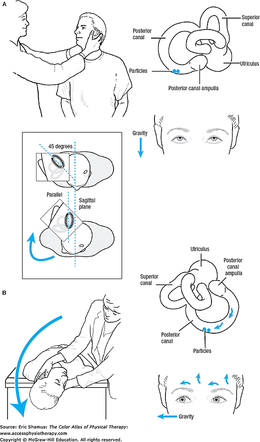 BENIGN PAROXYSMAL POSITIONAL VERTIGO AccessMedicine Network