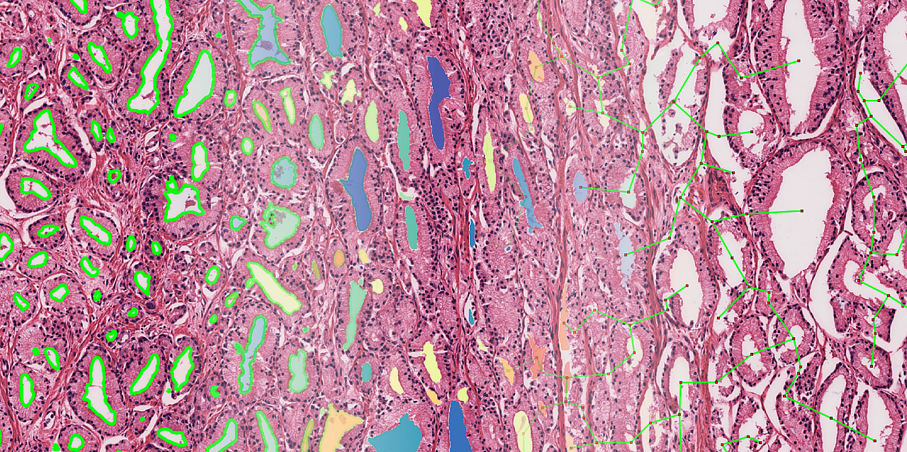 Machine learning on H&E slides could help identify patients that would benefit from additional