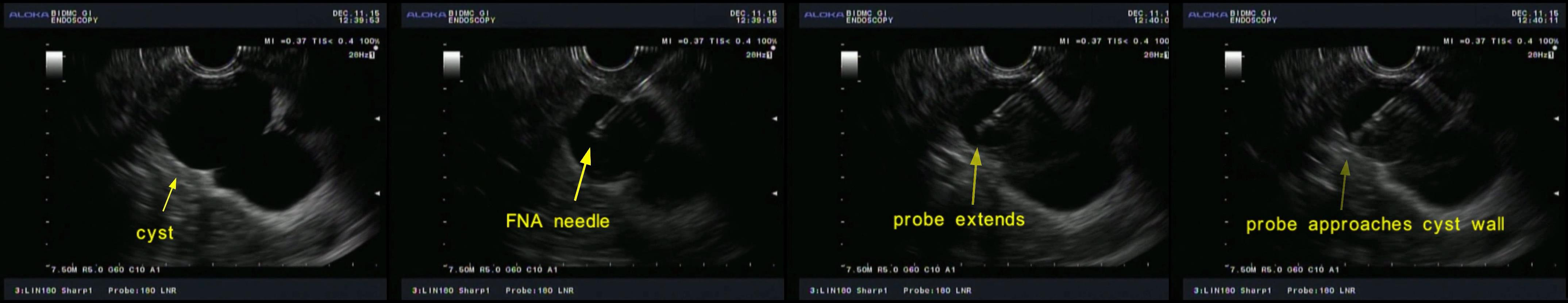 Figure 2. EUS images showing data collection from one of multiple spatial locations in a pancreatic cyst.
