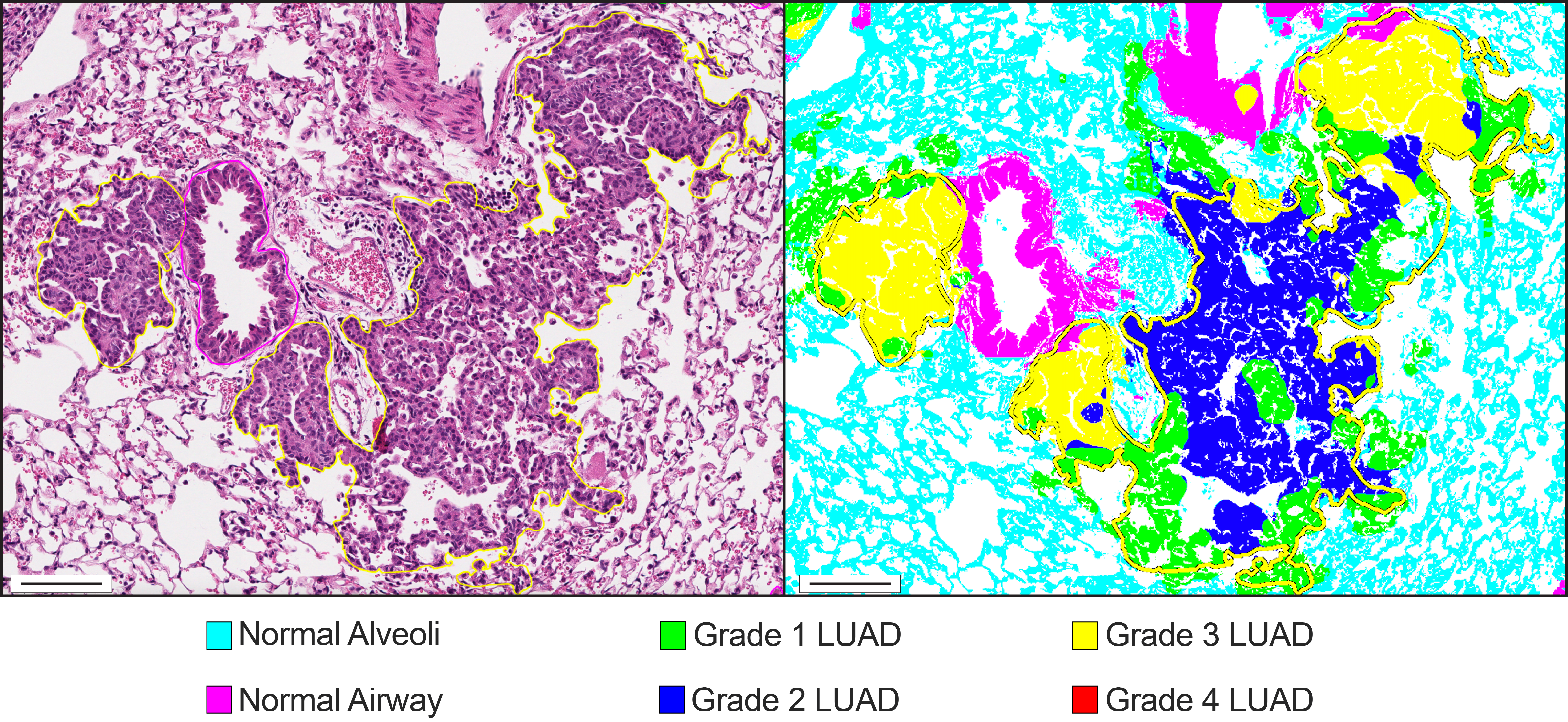 On left: A zoomed in image of two lung adenocarcinomas annotated as grade 3 by a human rater. On right: The pixel-level classifications of the same image performed by GLASS-AI shows large areas of grade 1 and grade 2 lung adenocarcinoma within the regions marked as grade 3 by the human rater.