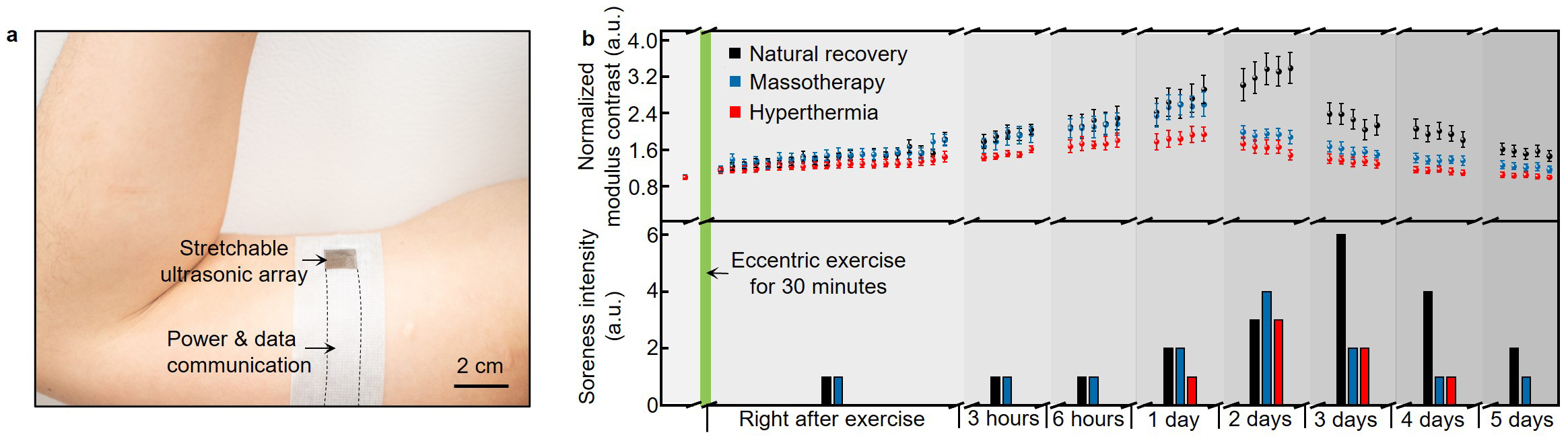 a, An optical image showing the device that conforms to upper arm. b, Serial monitoring results of normalized modulus contrast and soreness intensity of the biceps brachii muscle before and after the eccentric exercise. We mapped the modulus distribution of the muscle and then calculated the mean and standard deviations of the biceps brachii area, which were plotted at the top. Each point and error bar represent the result of one measurement. The time interval between adjacent tests is 1 min. In each physiotherapy session, data were normalized by the modulus contrast of the biceps brachii muscle before exercise. At the bottom, soreness scores were evaluated following the pain visual analogue scale.