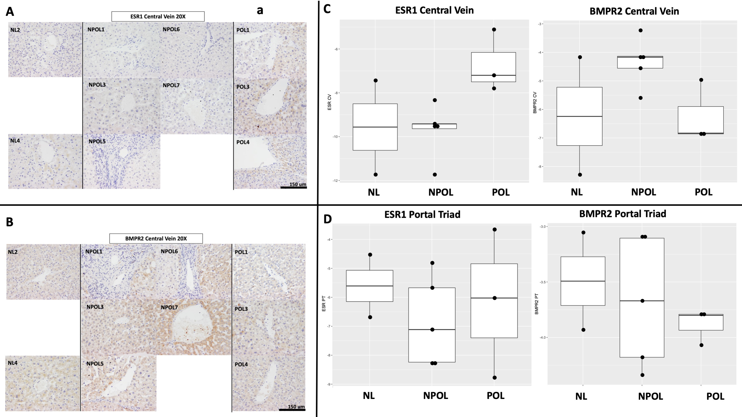 Increased protein expression of ESR1 (Panel A) and BMPR2 (Panel B) in PoPH relative to non-PoPH liver tissue, particularly in the region surrounding the central hepatic vein. This pattern corresponds with semi-quantitative immunohistochemistry increased for ESR1 and decreased for BMPR2 in PoPH versus non-PoPH cirrhosis liver tissue in the peri-central region (Panel C), a pattern not seen in the peri-portal region of the liver (Panel D). 