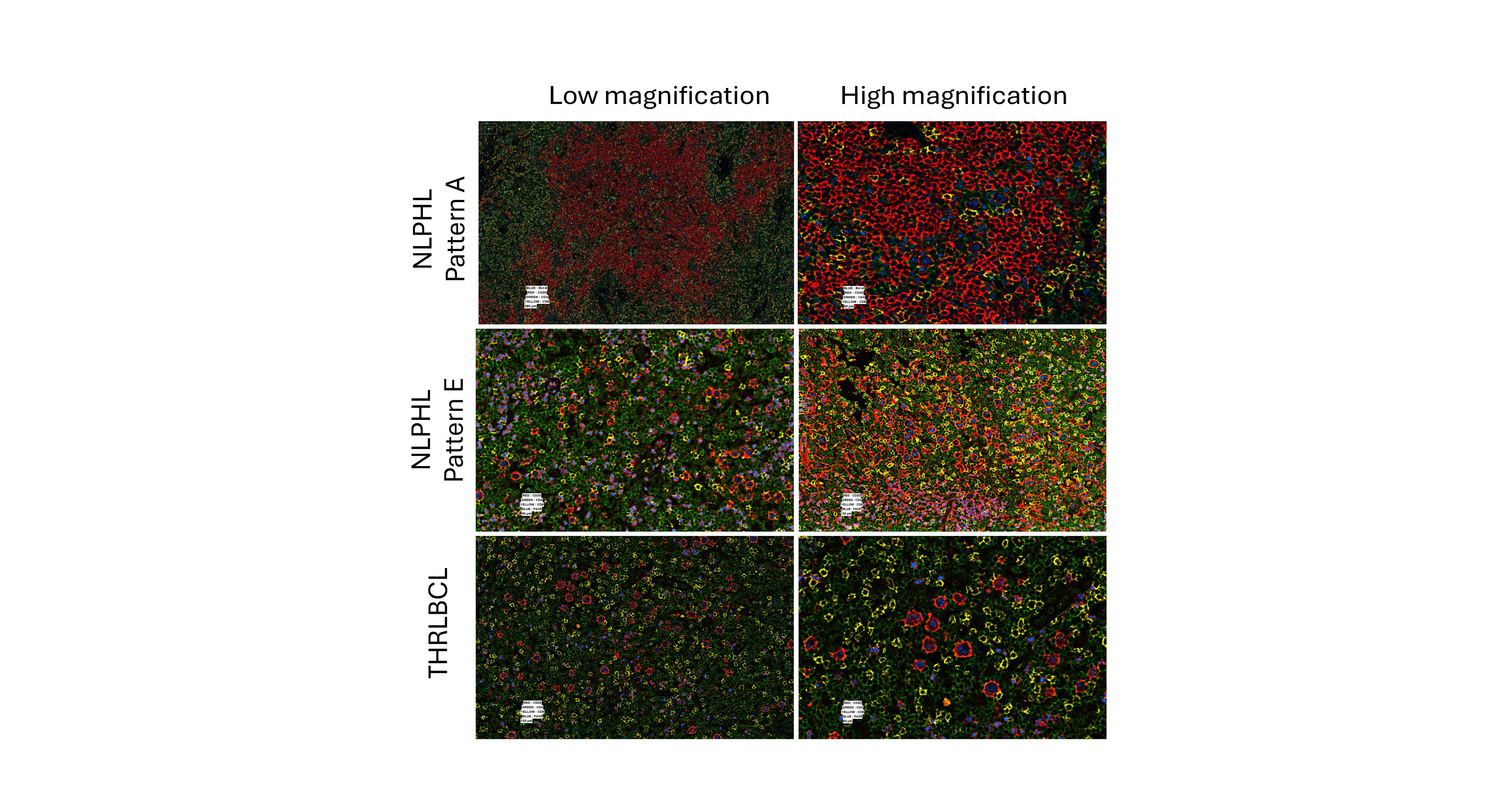 High-plex CODEX images show sparse tumor B-cells and complex cellular composition in the tumor microenvironment as revealed by a panel of 21 DNA-barcoded antibodies. Tumor B-cell size and numbers show a gradual increase from typical NLPHL pattern A (top row) to variant NLPHL pattern E (middle row), and THRLBCL (bottom row). Cell type content and composition including T-cell and macrophage subsets show distinct changes and spatial organization associated with nodular or diffuse growth patterns.
